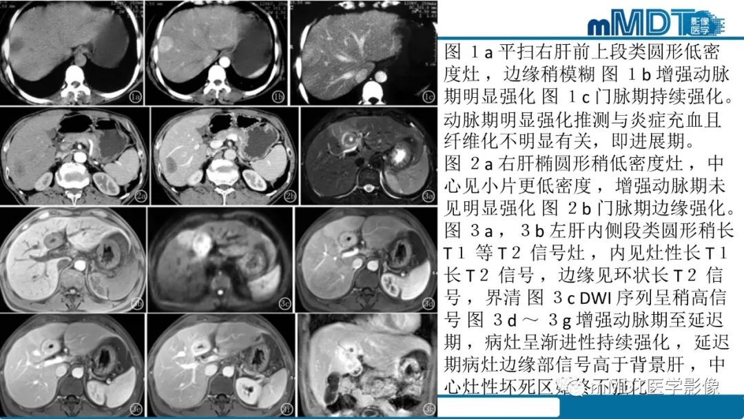 影像PPT - 【PPT】肝炎性肌纤维母细胞瘤-35 影像PPT - 【PPT】肝炎性肌纤维母细胞瘤-35