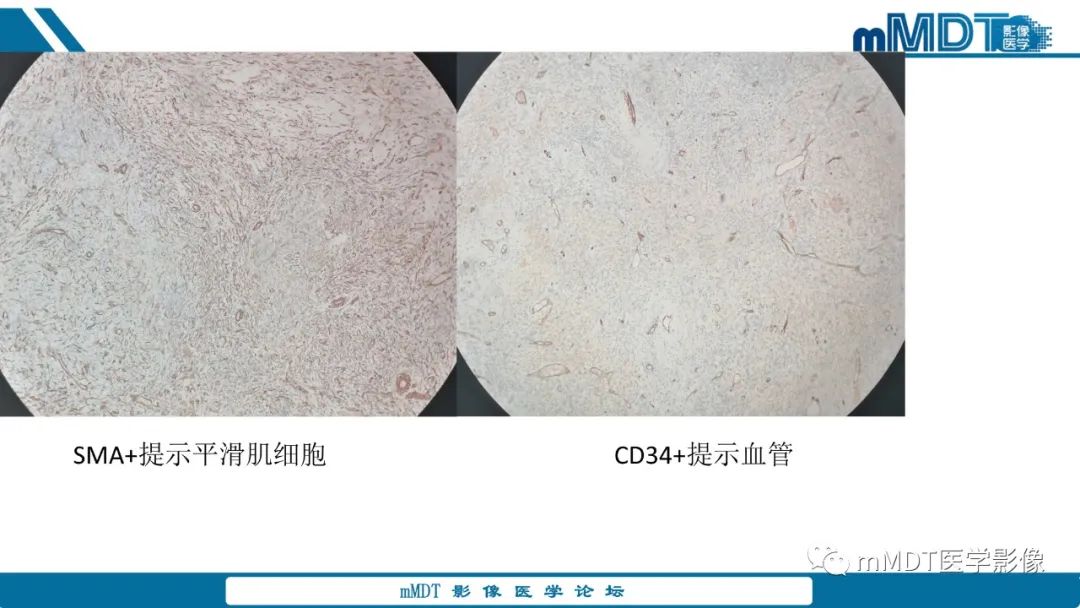 影像PPT - 【PPT】肝炎性肌纤维母细胞瘤-14 影像PPT - 【PPT】肝炎性肌纤维母细胞瘤-14