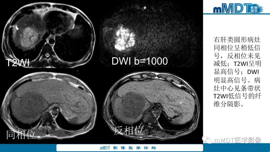 影像PPT - 【PPT】肝炎性肌纤维母细胞瘤-18 影像PPT - 【PPT】肝炎性肌纤维母细胞瘤-18