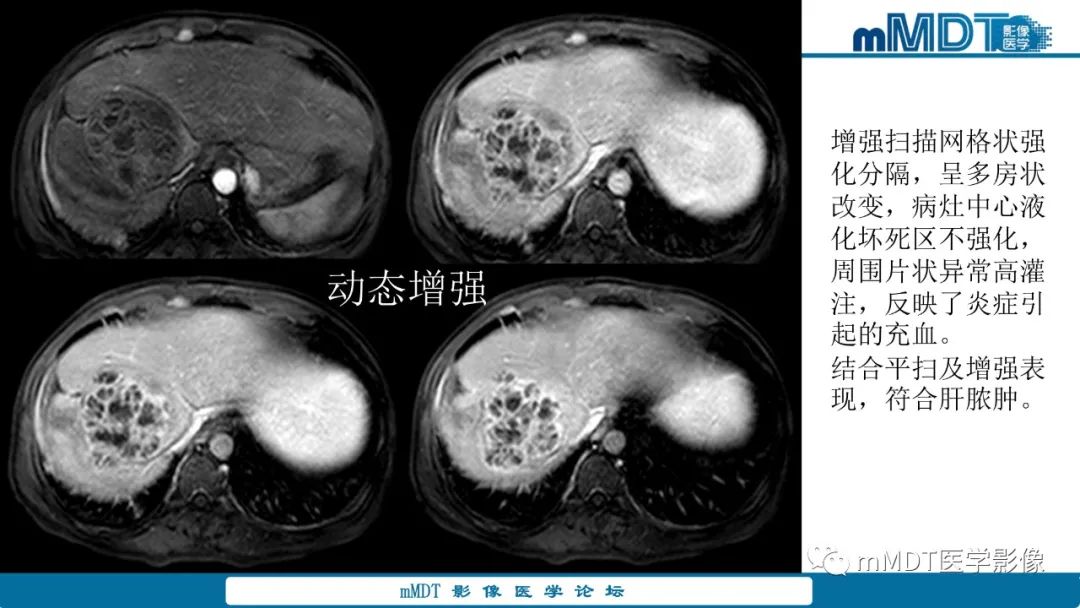 影像PPT - 【PPT】肝炎性肌纤维母细胞瘤-19 影像PPT - 【PPT】肝炎性肌纤维母细胞瘤-19