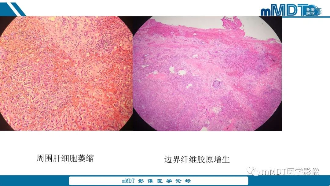 影像PPT - 【PPT】肝炎性肌纤维母细胞瘤-13 影像PPT - 【PPT】肝炎性肌纤维母细胞瘤-13
