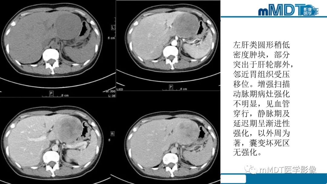 影像PPT - 【PPT】肝炎性肌纤维母细胞瘤-29 影像PPT - 【PPT】肝炎性肌纤维母细胞瘤-29