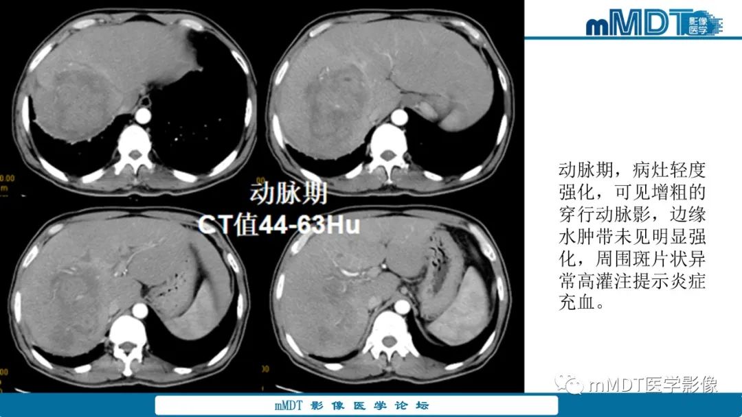影像PPT - 【PPT】肝炎性肌纤维母细胞瘤-1 影像PPT - 【PPT】肝炎性肌纤维母细胞瘤-1