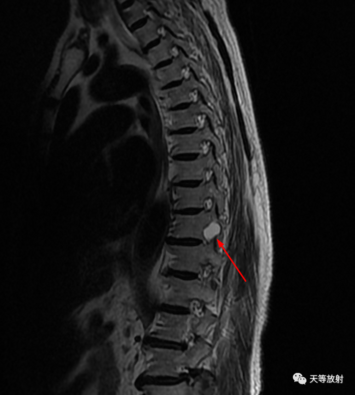 影像PPT - 【病例】脊膜囊肿1例MR影像-1 影像PPT - 【病例】脊膜囊肿1例MR影像-1