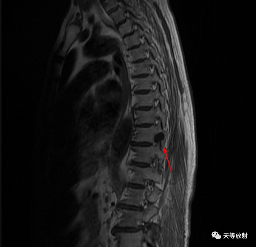 影像PPT - 【病例】脊膜囊肿1例MR影像-2 影像PPT - 【病例】脊膜囊肿1例MR影像-2