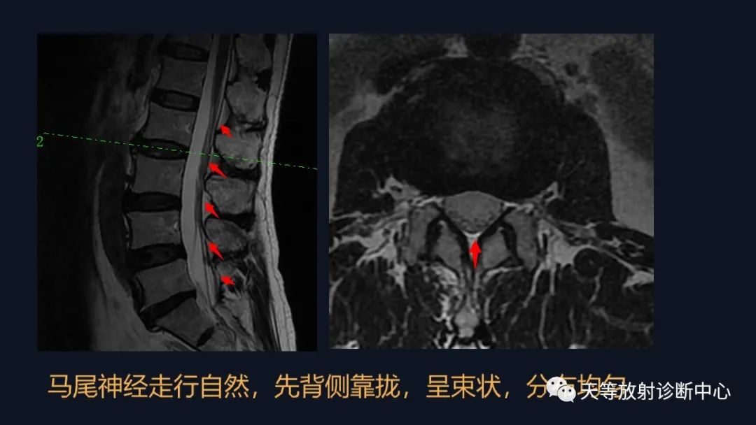 影像PPT - 马尾神经冗余征:马尾神经扭曲-3 影像PPT - 马尾神经冗余征:马尾神经扭曲-3