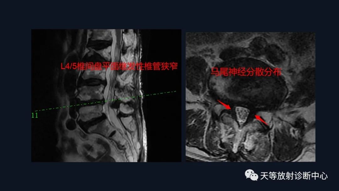 影像PPT - 马尾神经冗余征:马尾神经扭曲-8 影像PPT - 马尾神经冗余征:马尾神经扭曲-8