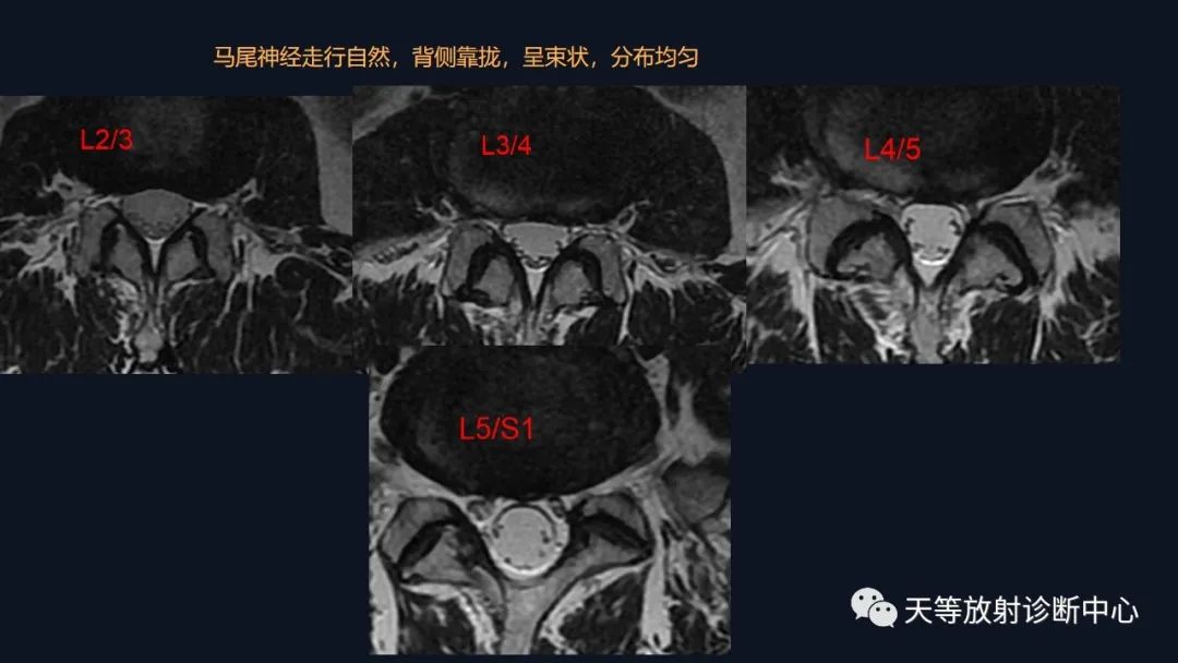 影像PPT - 马尾神经冗余征:马尾神经扭曲-4 影像PPT - 马尾神经冗余征:马尾神经扭曲-4
