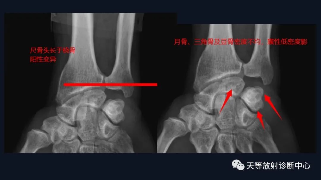影像PPT - 三角纤维软骨复合体(TFCC)损伤-3 影像PPT - 三角纤维软骨复合体(TFCC)损伤-3