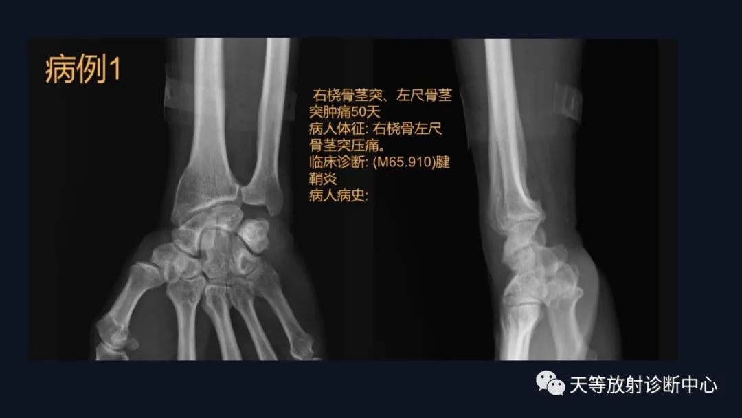 影像PPT - 三角纤维软骨复合体(TFCC)损伤-1 影像PPT - 三角纤维软骨复合体(TFCC)损伤-1