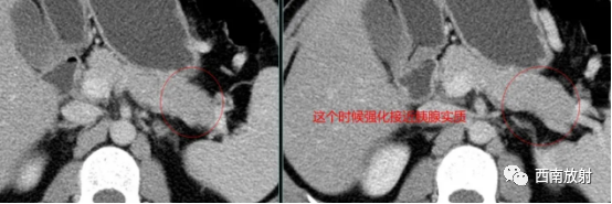 影像PPT - 胰腺神经内分泌肿瘤-7 影像PPT - 胰腺神经内分泌肿瘤-7