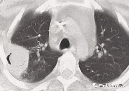 影像PPT - 22个肺部疾病的CT征象-4 影像PPT - 22个肺部疾病的CT征象-4