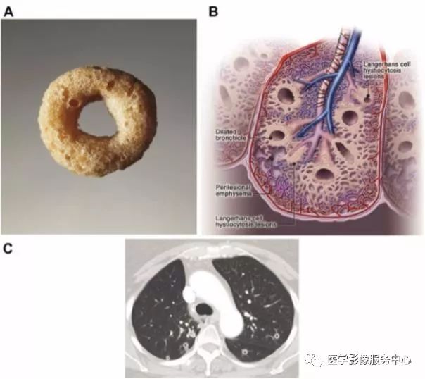 影像PPT - 22个肺部疾病的CT征象-8 影像PPT - 22个肺部疾病的CT征象-8