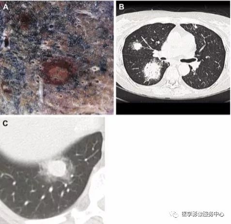 影像PPT - 22个肺部疾病的CT征象-6 影像PPT - 22个肺部疾病的CT征象-6