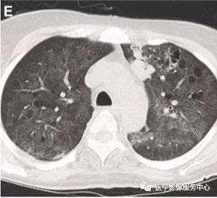 影像PPT - 22个肺部疾病的CT征象-14 影像PPT - 22个肺部疾病的CT征象-14