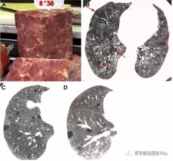 影像PPT - 22个肺部疾病的CT征象-15 影像PPT - 22个肺部疾病的CT征象-15