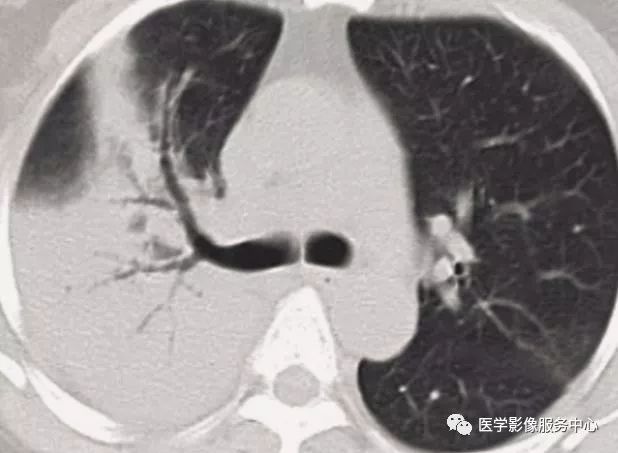 影像PPT - 22个肺部疾病的CT征象-18 影像PPT - 22个肺部疾病的CT征象-18