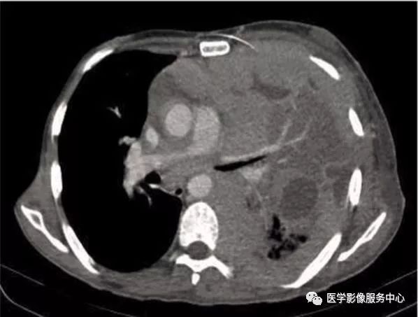 影像PPT - 22个肺部疾病的CT征象-22 影像PPT - 22个肺部疾病的CT征象-22