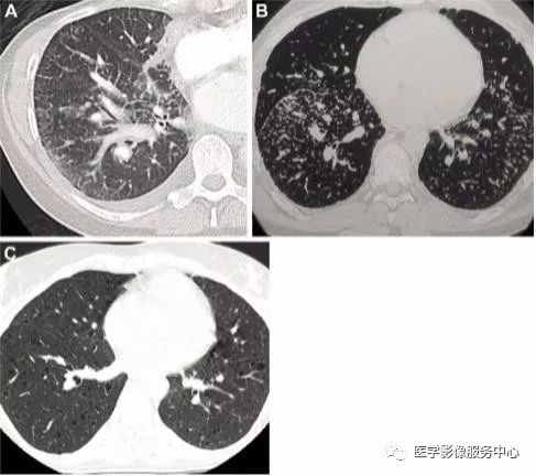 影像PPT - 22个肺部疾病的CT征象-3 影像PPT - 22个肺部疾病的CT征象-3