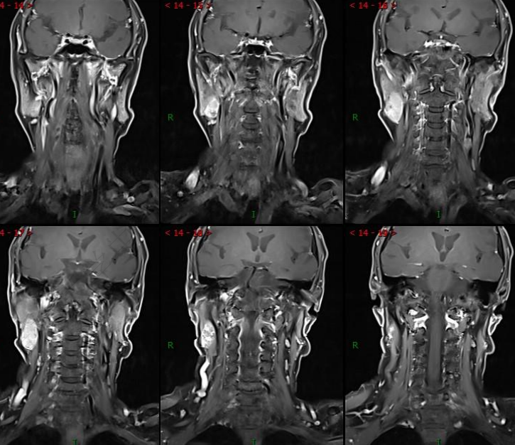 影像PPT - 【病例】腮腺腺淋巴瘤1例MR影像诊断-7 影像PPT - 【病例】腮腺腺淋巴瘤1例MR影像诊断-7