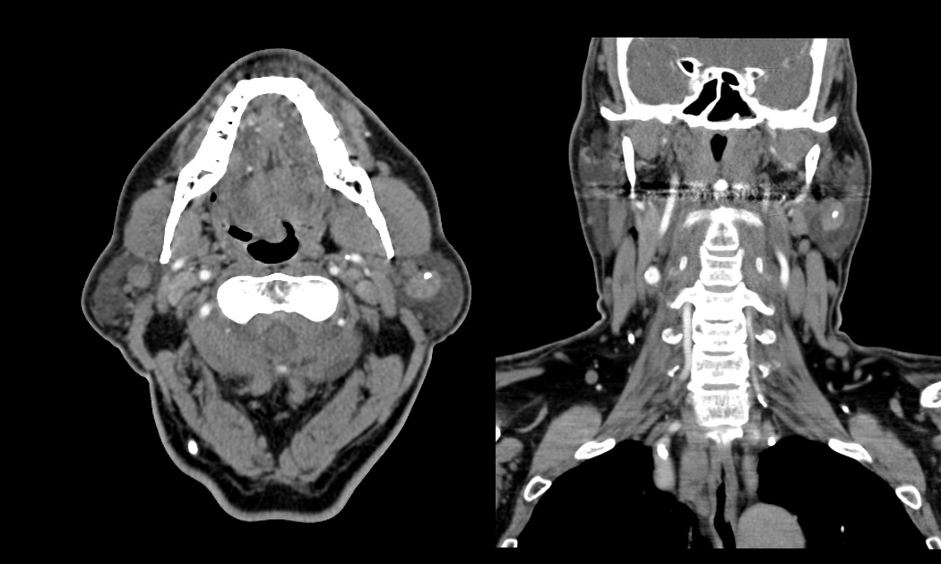 影像PPT - 【病例】腮腺腺淋巴瘤1例MR影像诊断-13 影像PPT - 【病例】腮腺腺淋巴瘤1例MR影像诊断-13