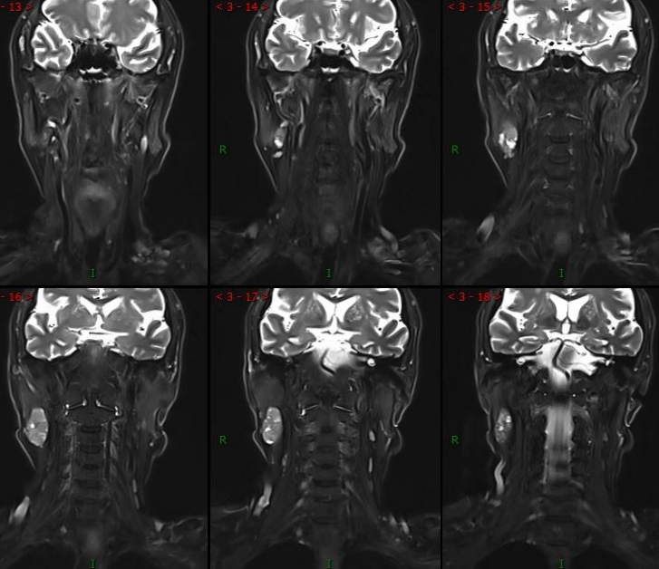 影像PPT - 【病例】腮腺腺淋巴瘤1例MR影像诊断-4 影像PPT - 【病例】腮腺腺淋巴瘤1例MR影像诊断-4