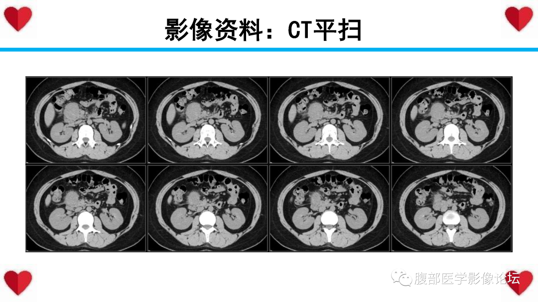 影像PPT - 【PPT】胰腺实性假乳头状瘤（SPN）影像诊断-6