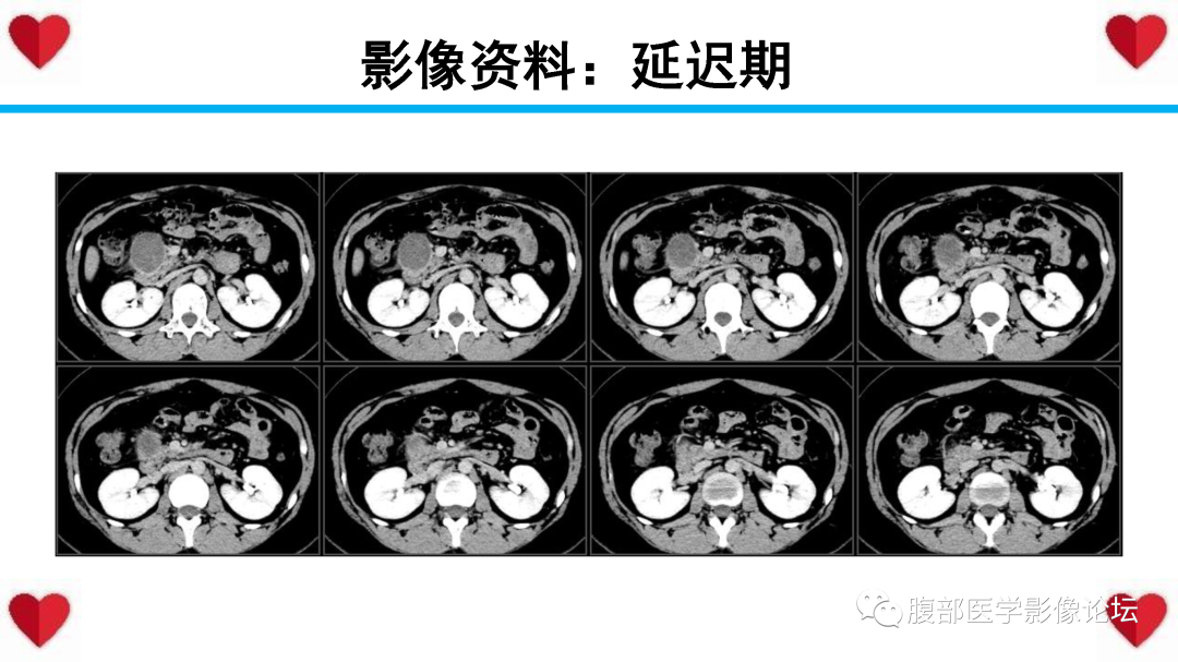 影像PPT - 【PPT】胰腺实性假乳头状瘤（SPN）影像诊断-12