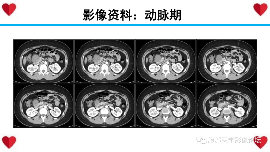 影像PPT - 【PPT】胰腺实性假乳头状瘤（SPN）影像诊断-8