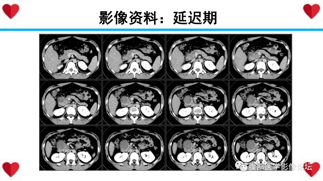 影像PPT - 【PPT】胰腺实性假乳头状瘤（SPN）影像诊断-11