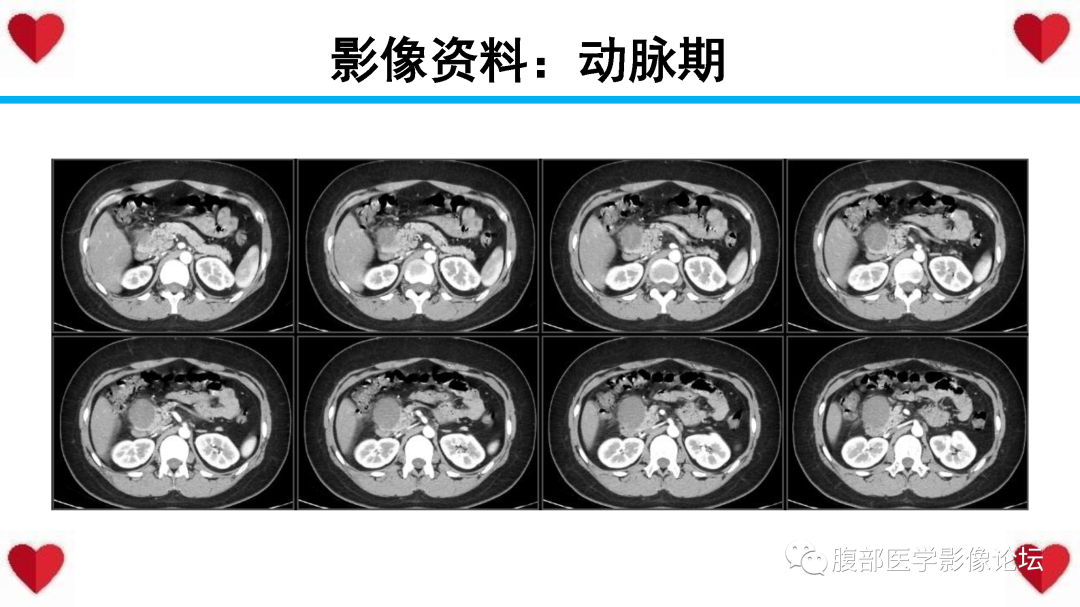 影像PPT - 【PPT】胰腺实性假乳头状瘤（SPN）影像诊断-7