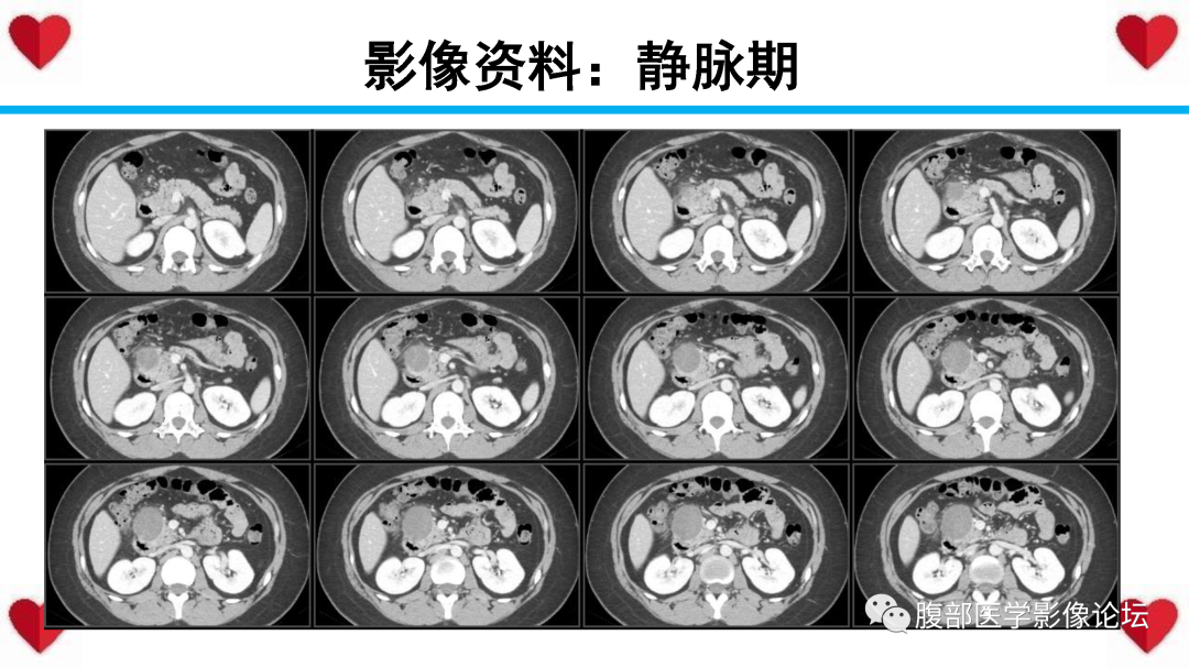 影像PPT - 【PPT】胰腺实性假乳头状瘤（SPN）影像诊断-9