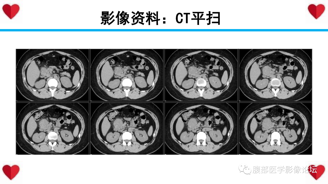 影像PPT - 【PPT】胰腺实性假乳头状瘤（SPN）影像诊断-5