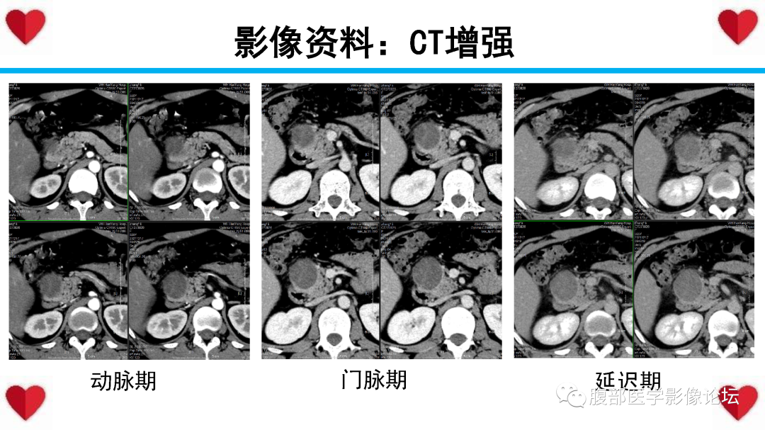 影像PPT - 【PPT】胰腺实性假乳头状瘤（SPN）影像诊断-13