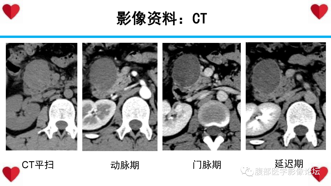影像PPT - 【PPT】胰腺实性假乳头状瘤（SPN）影像诊断-14
