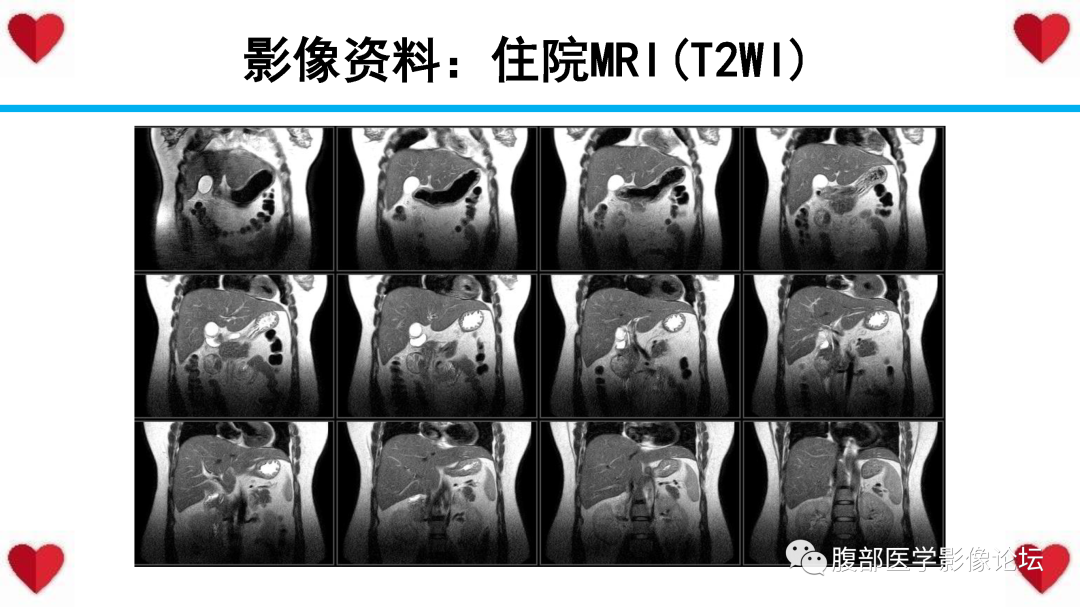 影像PPT - 【PPT】胰腺实性假乳头状瘤（SPN）影像诊断-15