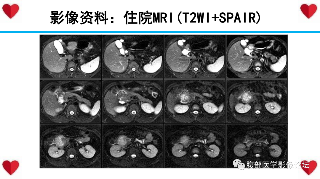 影像PPT - 【PPT】胰腺实性假乳头状瘤（SPN）影像诊断-16