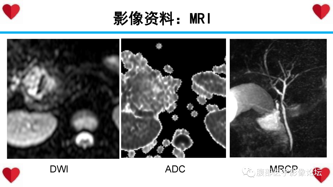 影像PPT - 【PPT】胰腺实性假乳头状瘤（SPN）影像诊断-21