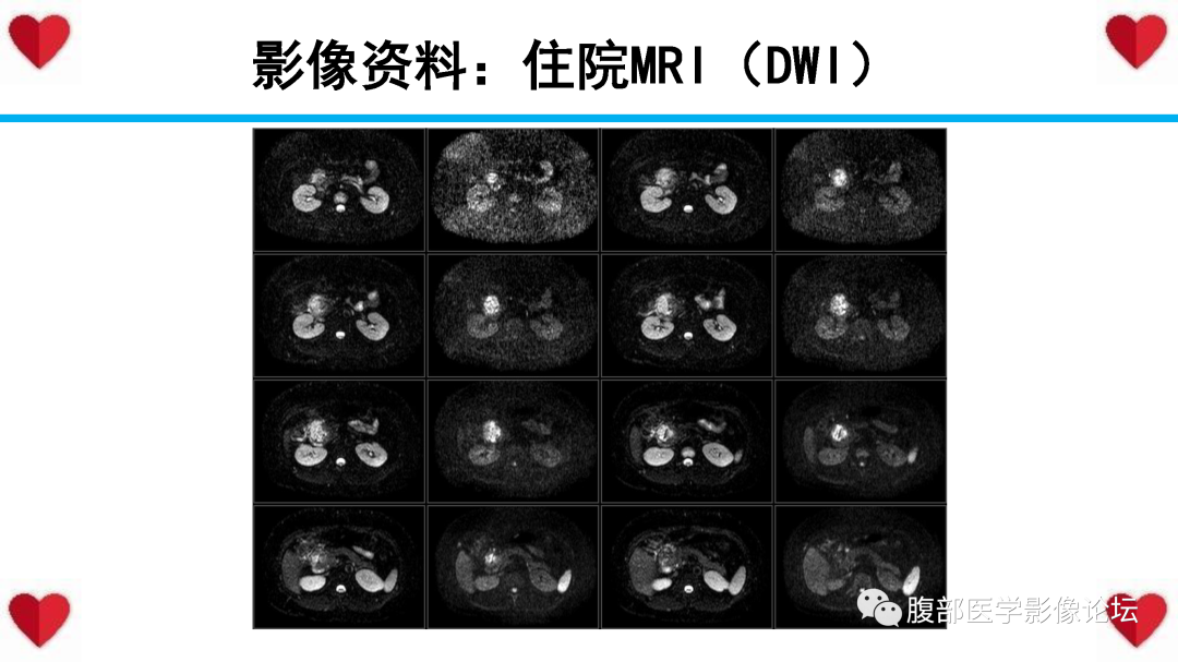 影像PPT - 【PPT】胰腺实性假乳头状瘤（SPN）影像诊断-18
