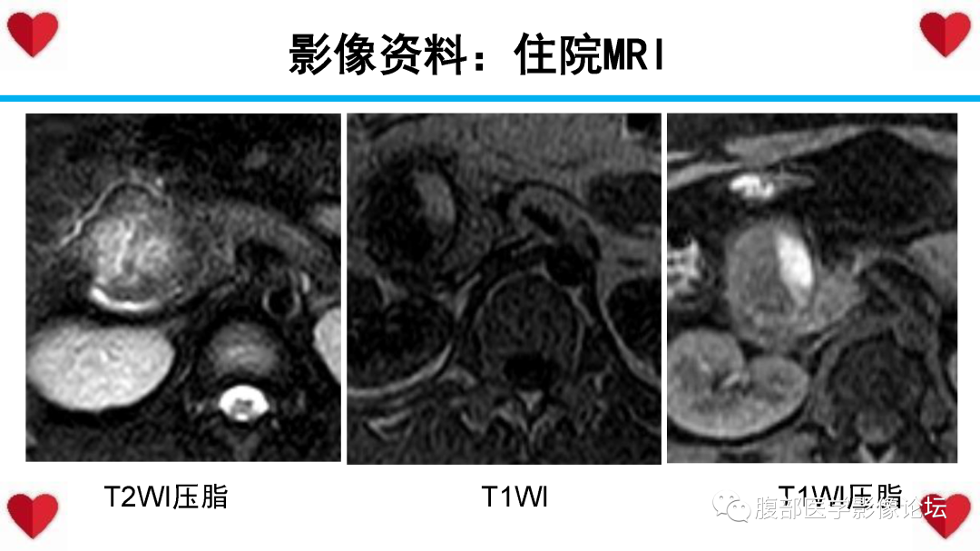 影像PPT - 【PPT】胰腺实性假乳头状瘤（SPN）影像诊断-20