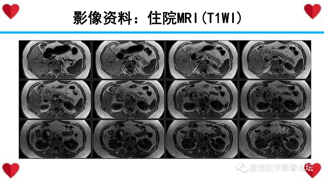 影像PPT - 【PPT】胰腺实性假乳头状瘤（SPN）影像诊断-17