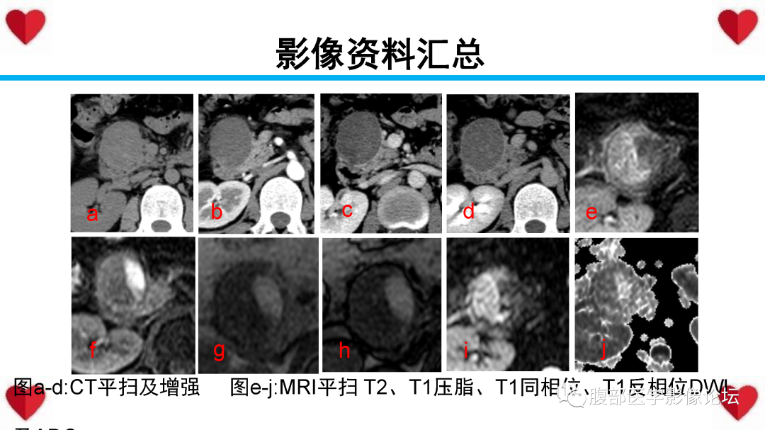 影像PPT - 【PPT】胰腺实性假乳头状瘤（SPN）影像诊断-22