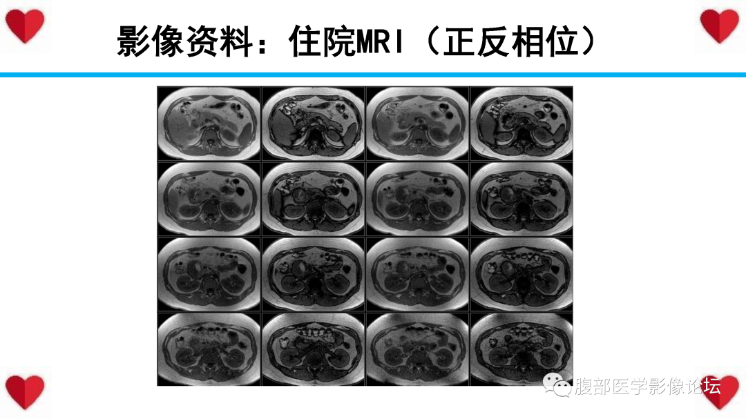 影像PPT - 【PPT】胰腺实性假乳头状瘤（SPN）影像诊断-19