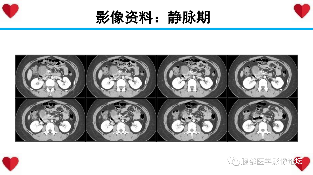 影像PPT - 【PPT】胰腺实性假乳头状瘤（SPN）影像诊断-10