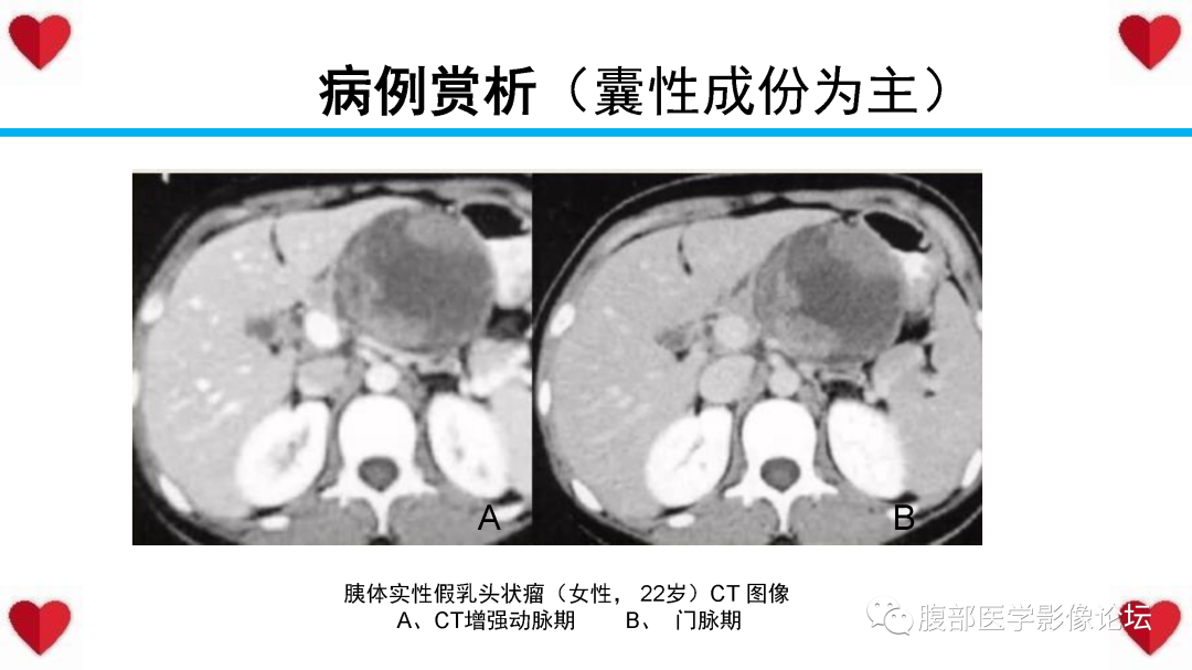 影像PPT - 【PPT】胰腺实性假乳头状瘤（SPN）影像诊断-39