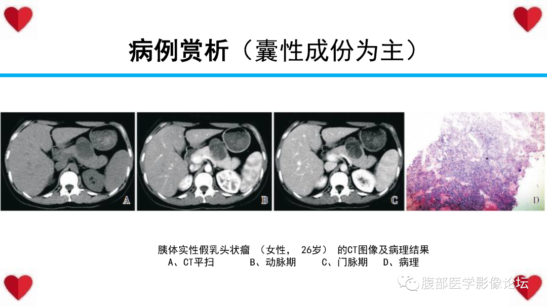 影像PPT - 【PPT】胰腺实性假乳头状瘤（SPN）影像诊断-38