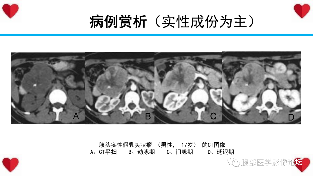 影像PPT - 【PPT】胰腺实性假乳头状瘤（SPN）影像诊断-42