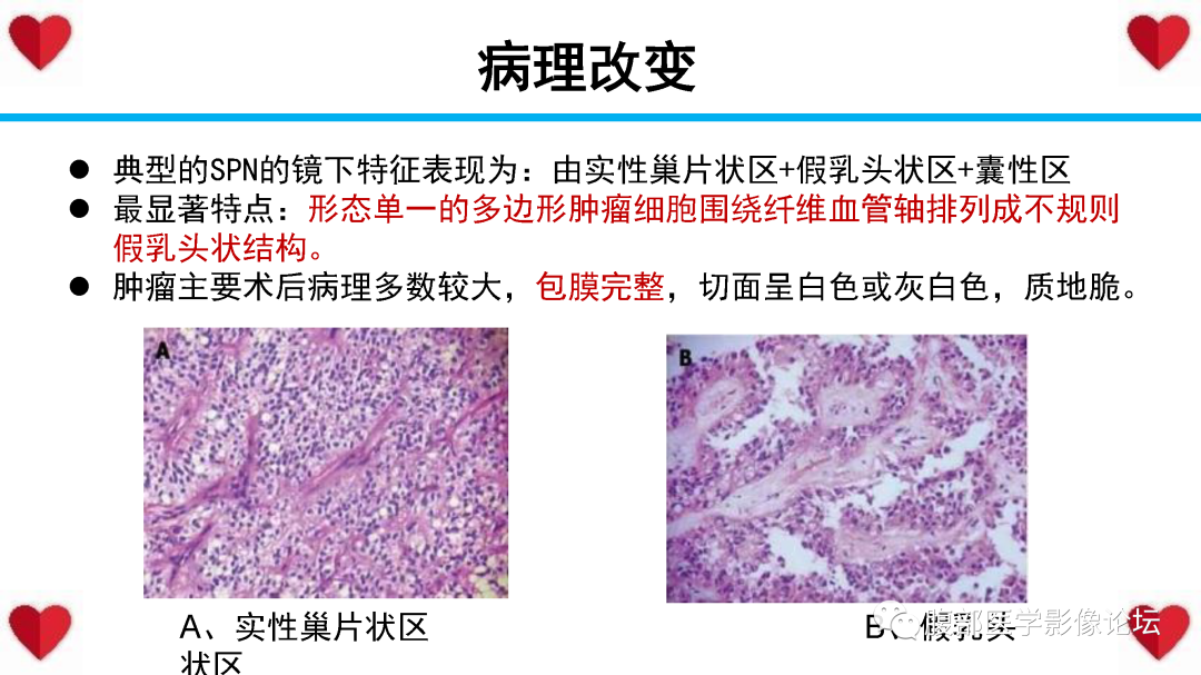影像PPT - 【PPT】胰腺实性假乳头状瘤（SPN）影像诊断-33