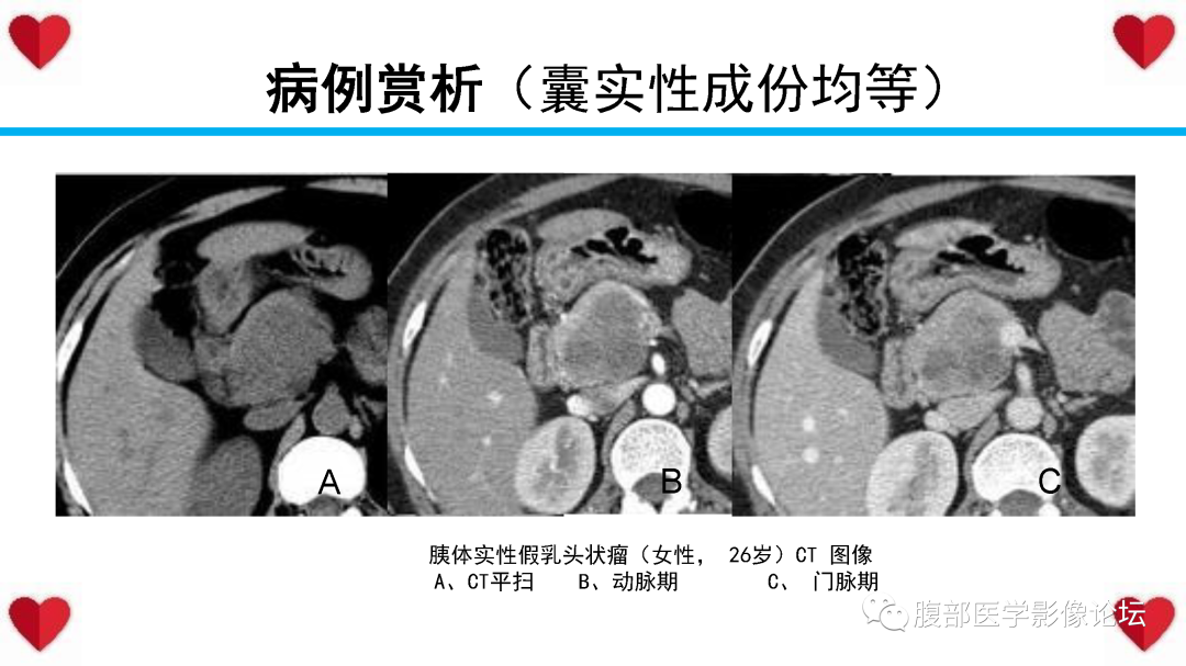 影像PPT - 【PPT】胰腺实性假乳头状瘤（SPN）影像诊断-40