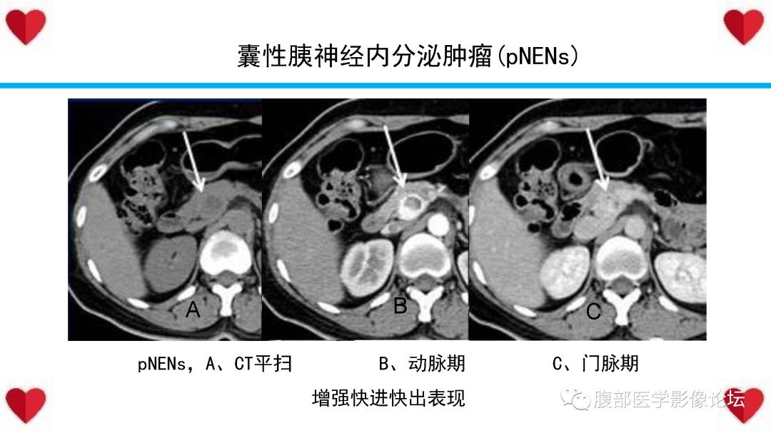 影像PPT - 【PPT】胰腺实性假乳头状瘤（SPN）影像诊断-47